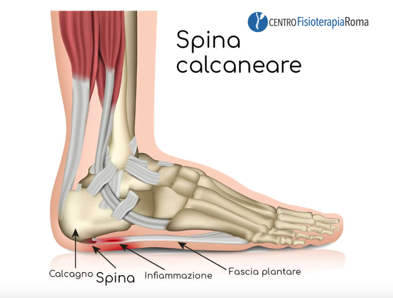 LA SPINA CALCANEARE Centro Fisioterapia Roma